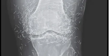 Les genoux dune femme revelent a la radiographie la presence de centaines daiguilles en or.jpg