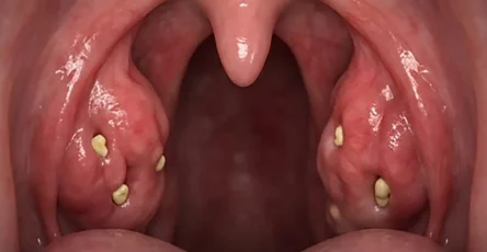 Pourquoi de petits cailloux blancs et malodorants apparaissent ils dans la bouche .jpg