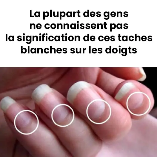 Que signifie les taches blanches sur les ongles.jpg