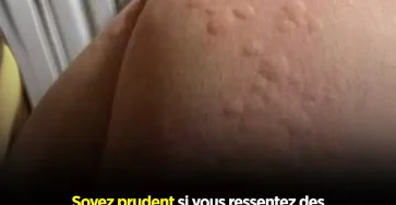 Soyez prudent si votre corps vous demange et que ces boutons apparaissent sur votre peau.jpg