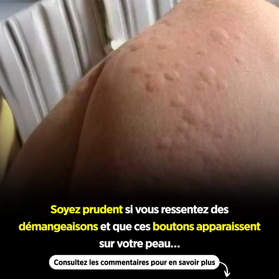 Soyez prudent si votre corps vous demange et que ces boutons apparaissent sur votre peau.jpg
