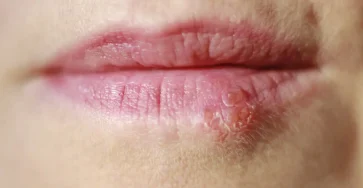 Une cloque sur la levre voici ce que votre corps veut vous dire et comment lapaiser naturellement.jpg