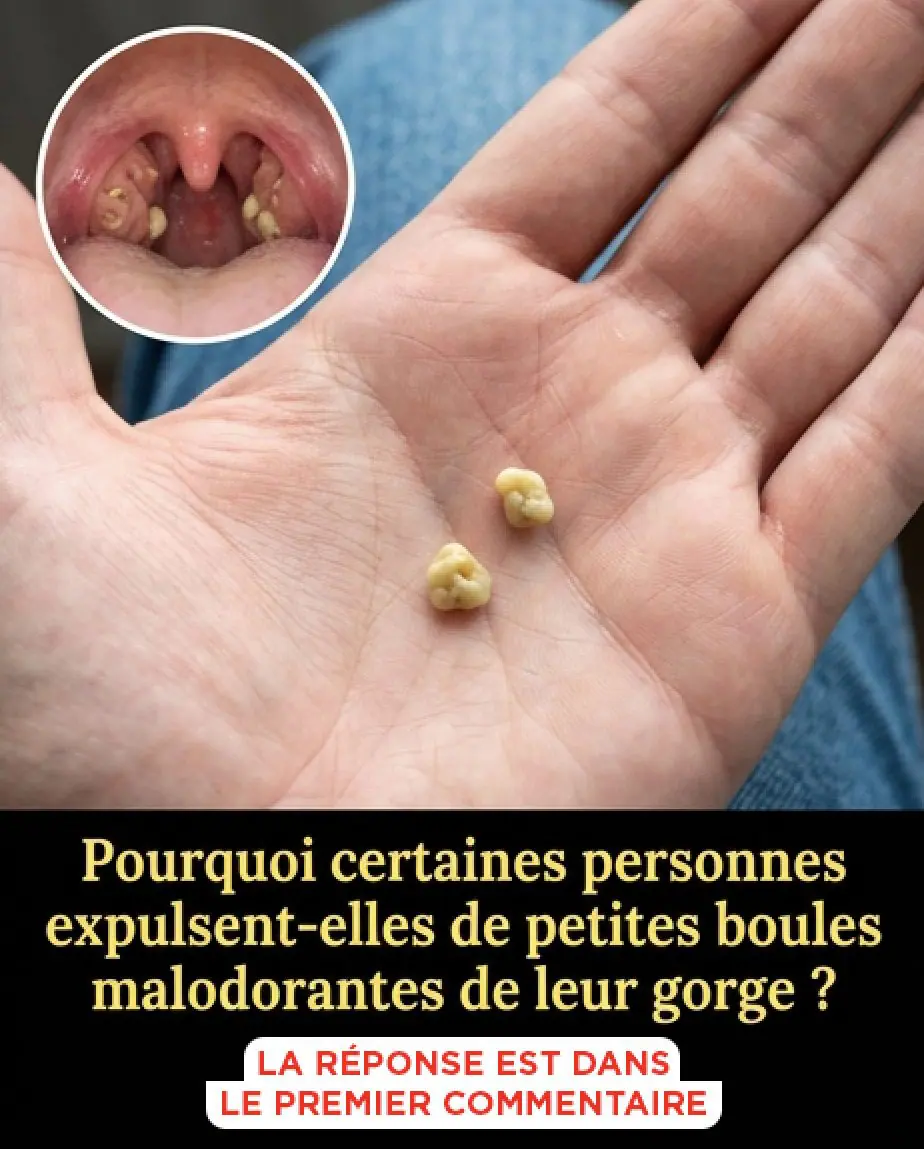 Les calculs biliaires que sont ils et comment sen debarrasser.jpg