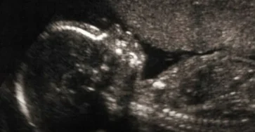 Et si lautisme laissait une trace invisible des la naissance 819x1024.jpg