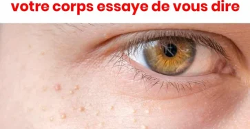 Si vous remarquez de petites protuberances blanches sur votre visage evitez de les retirer par vous meme 1024x1024.jpg
